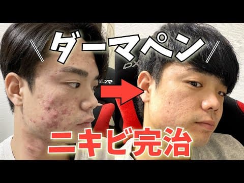 ニキビ肌、クレーター治すために初めてのダーマペン!施術の経過、費用、気になることを全てお話します。